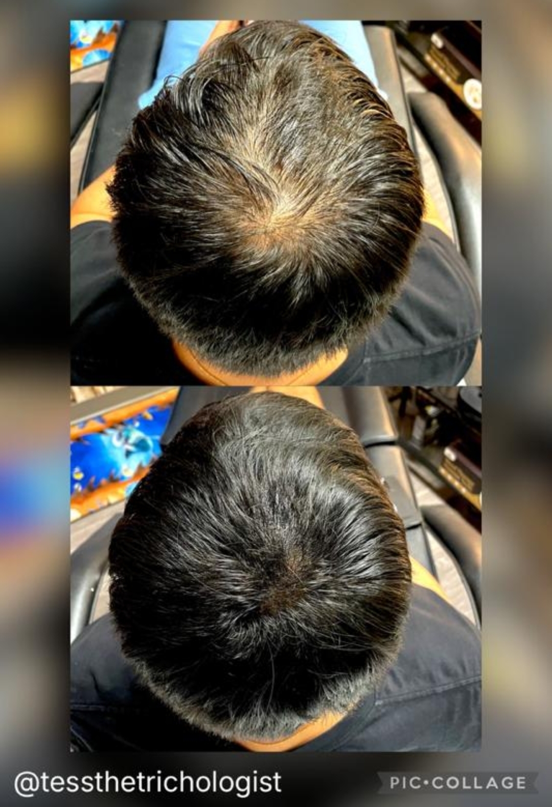 Before and after of rSMP™ density work by Tess Anifowoshe on a client with existing hair and visible scalp at the crown
